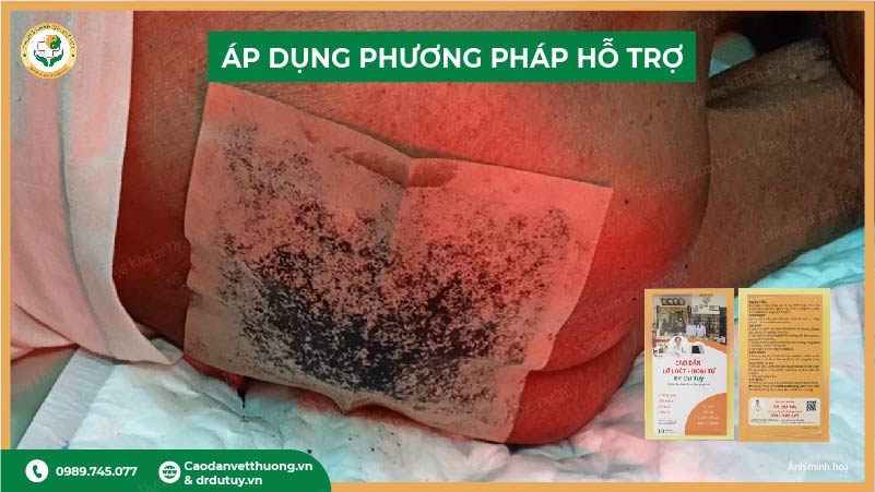 áp dụng phương pháp hỗ trợ sớm cho loét cùng cụt