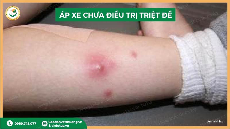 áp xe chưa điều trị triệt để