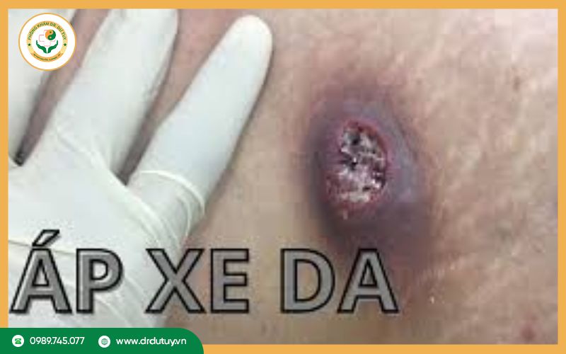 Các biến chứng nguy hiểm nếu không điều trị áp xe da kịp thời