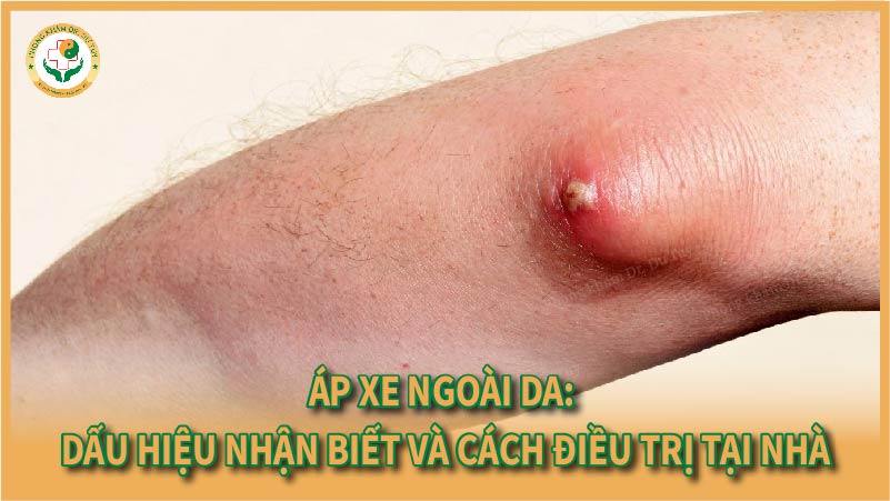 Áp xe ngoài da: Dấu hiệu nhận biết và cách điều trị tại nhà