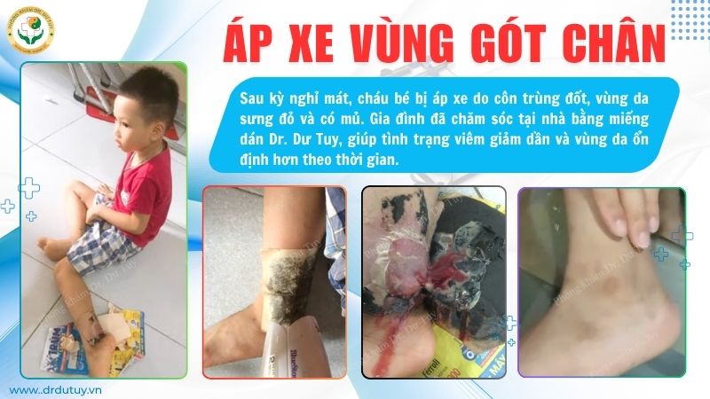 áp xe gót chân trẻ em côn trùng đốt