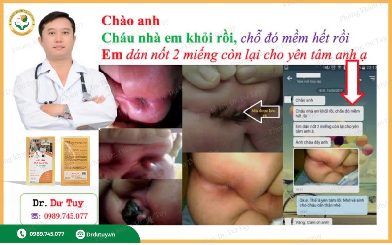 áp xe hậu môn ở trẻ sơ sinh
