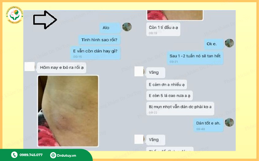 áp xe hồi phục gần khỏi