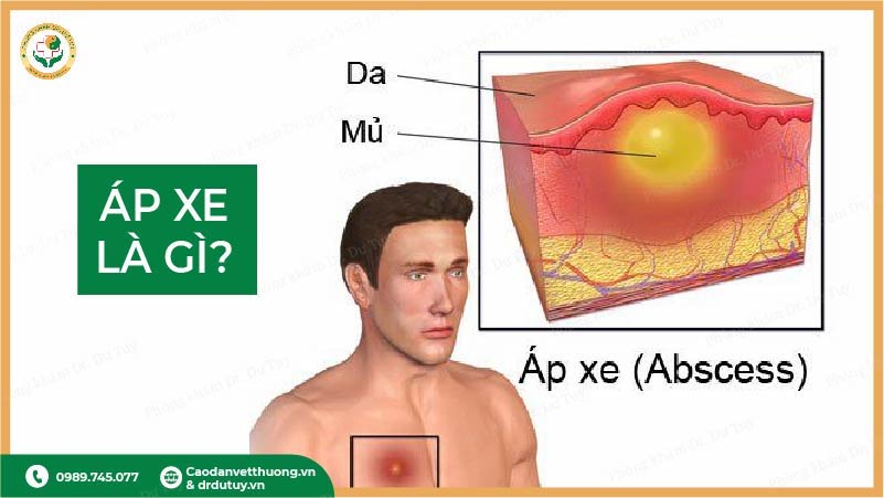 áp xe là gì mô tả
