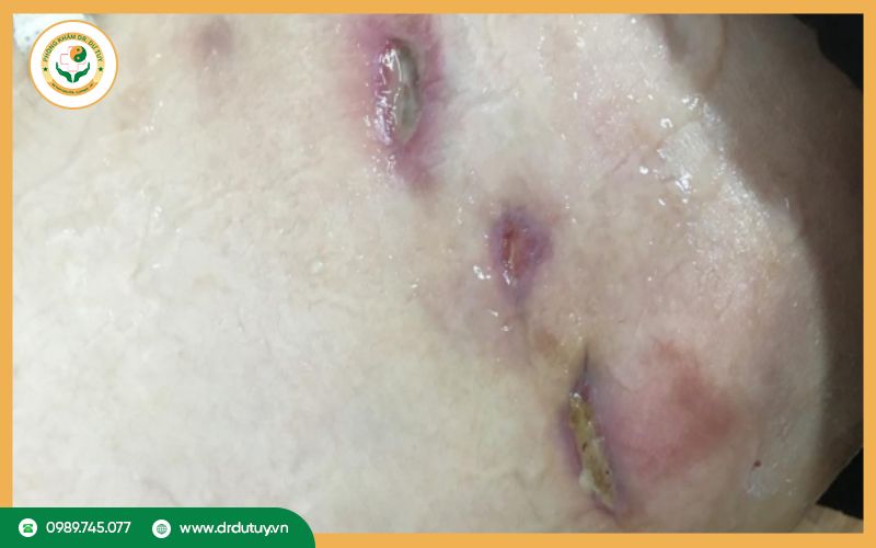 Áp xe lạnh là gì?