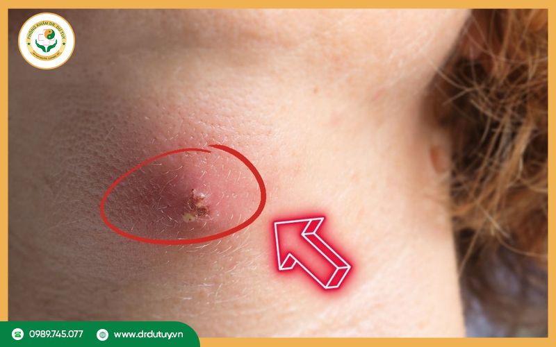 Triệu chứng của áp xe lạnh