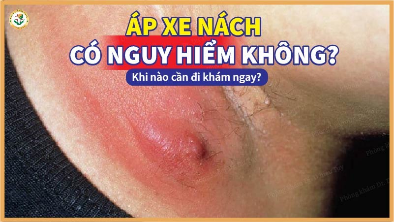 Áp xe nách có nguy hiểm không? Khi nào cần đi khám ngay?