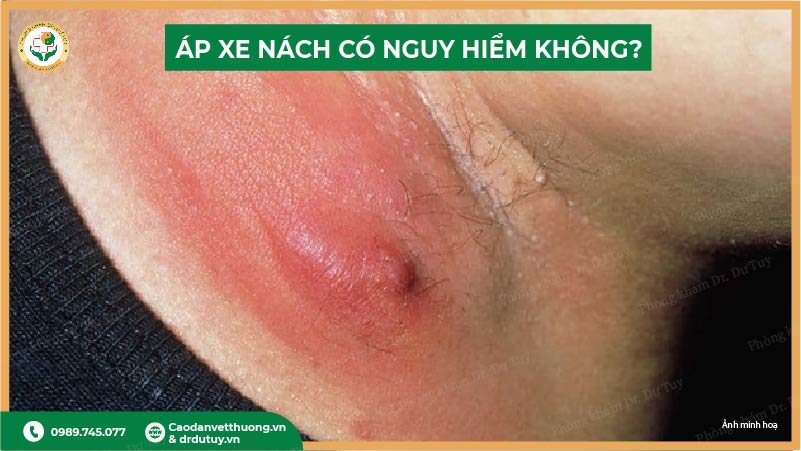 áp xe nách có nguy hiểm không?