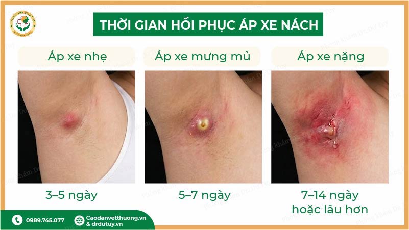 áp xe nách nặng nguy hiểm