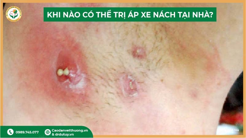 áp xe nách nhẹ có thể tự điều trị
