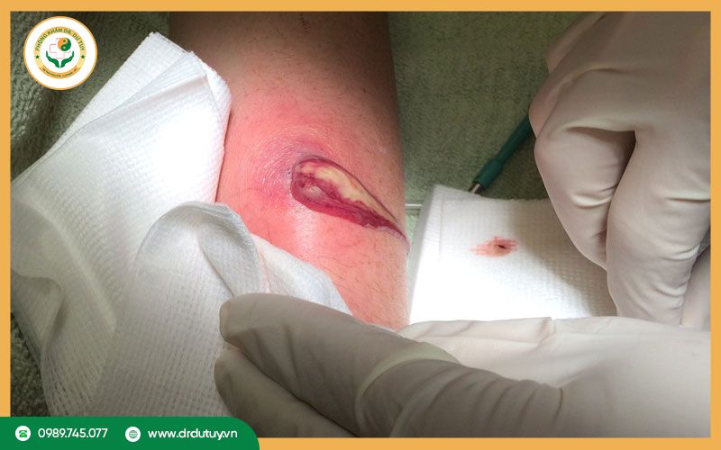 Chẩn đoán và điều trị áp xe ở mông