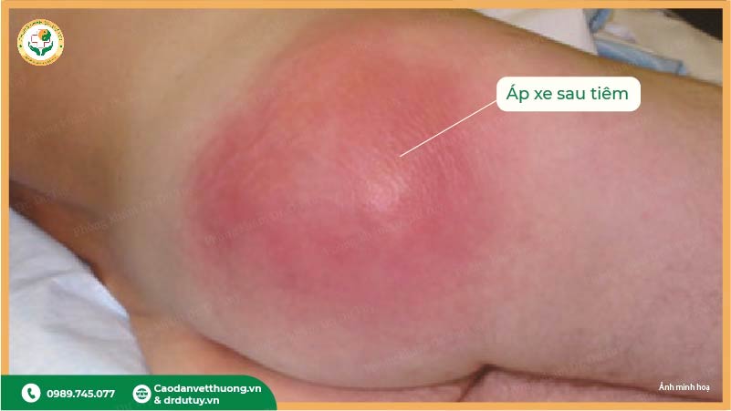 áp xe sau tiêm sưng đỏ viêm nhiễm