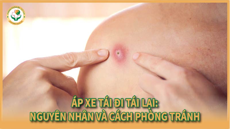 Áp xe tái đi tái lại: Nguyên nhân và cách phòng tránh