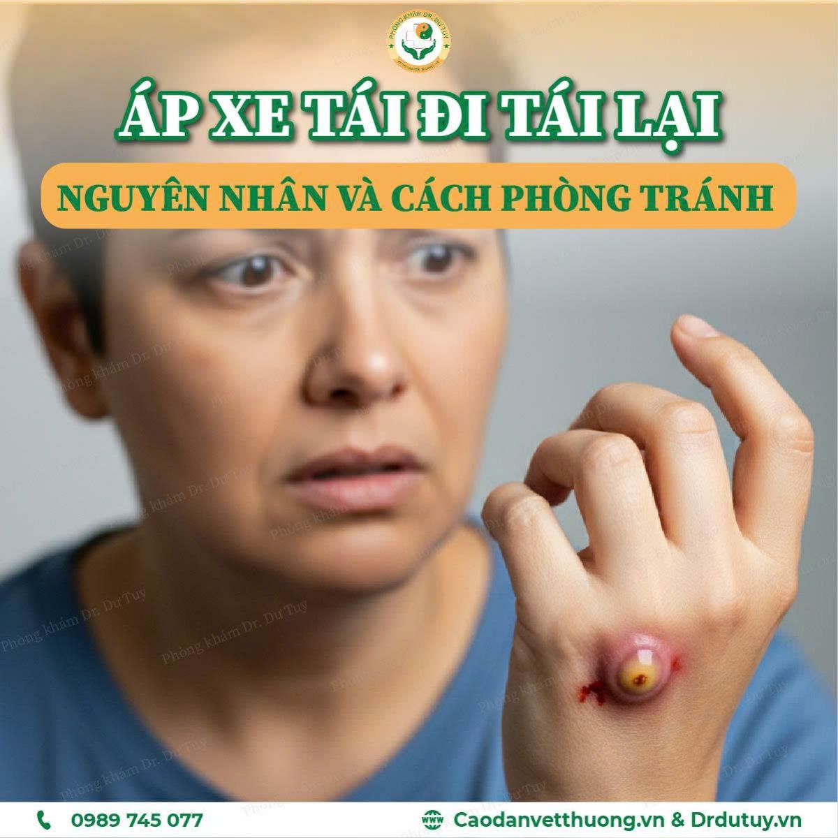 áp xe tái diễn nguyên nhân phòng tránh