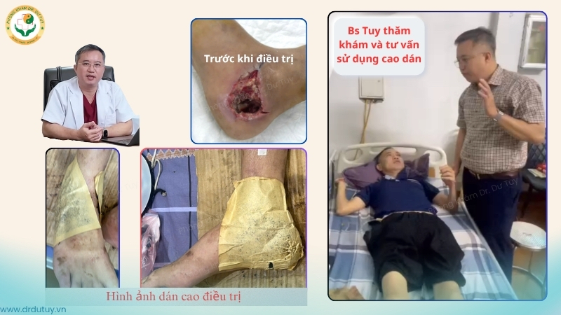 bác sĩ Tuy tư vấn cao dán điều trị vết thương gót chân