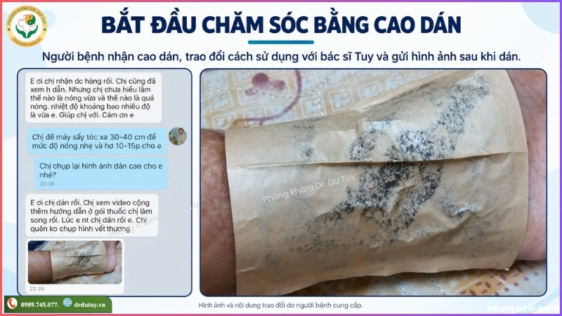 bắt đầu chăm sóc vết loét bằng cao dán