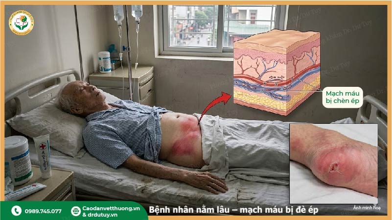 bất động kéo dài gây loét tỳ đè