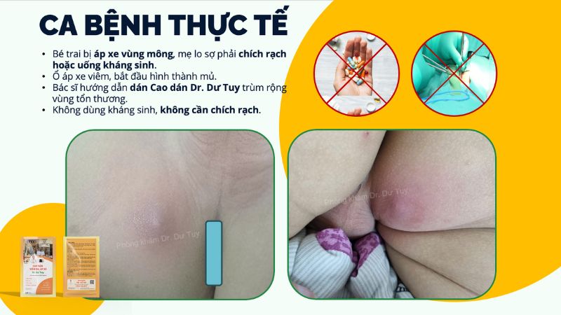 bé bị áp xe