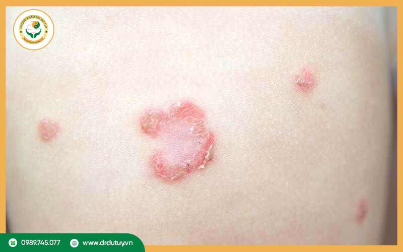 Bệnh chốc lở bao lâu thì khỏi? Cách nhận biết và điều trị nhanh phục hồi