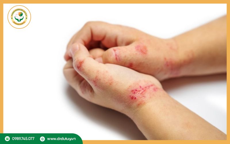 Bệnh chốc lở có nguy hiểm không?