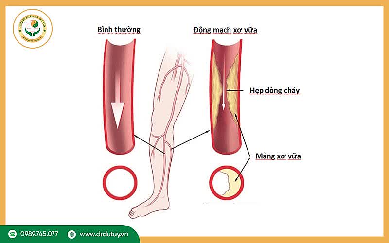 Bệnh động mạch ngoại biên là gì ?