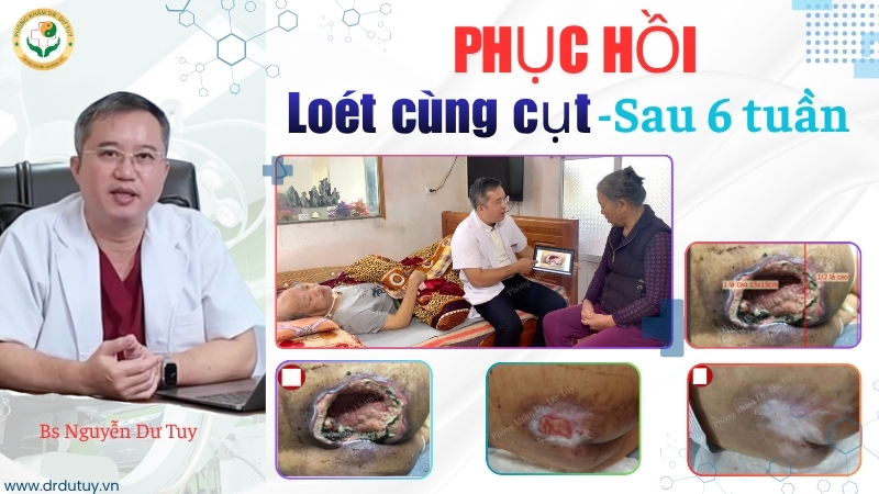 bệnh nhân 74 tuổi hồi phục vết loét cùng cụt