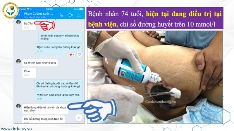 bệnh nhân 74 tuổi loét cùng cụt tiểu đường