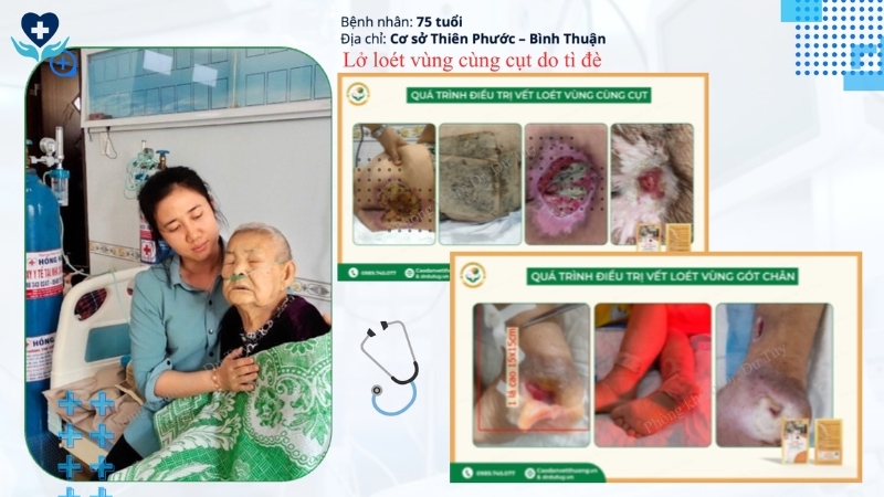 bệnh nhân 75 tuổi loét cùng cụt