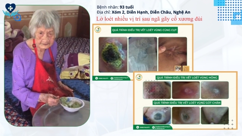 bệnh nhân 93 tuổii loét da sau ngã