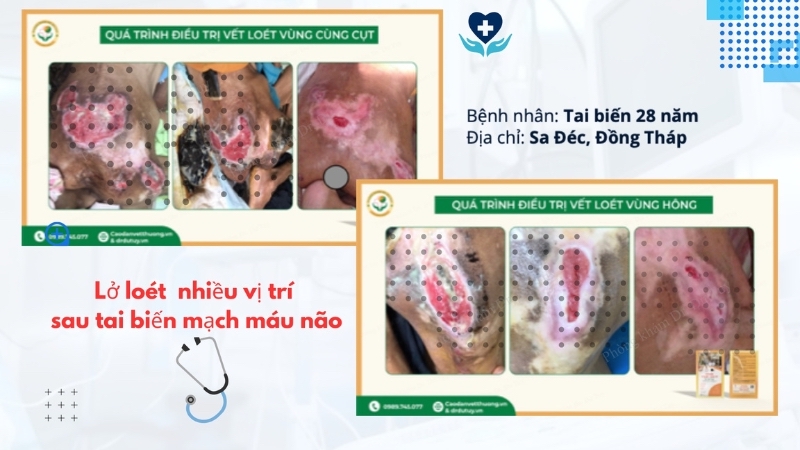bệnh nhân tai biến loét da nhiều vị trí