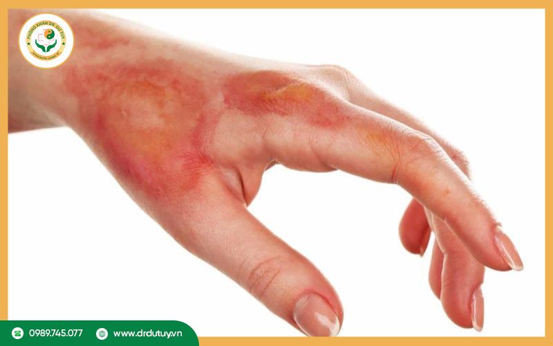 Bị bỏng nên làm gì? Cách sơ cứu và xử lý đúng giúp vết bỏng nhanh lành