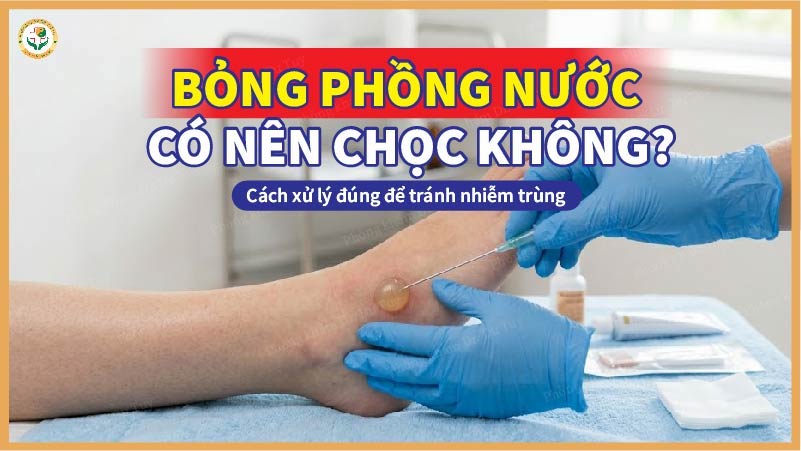 bị bỏng phồng nước có nên chọc không?