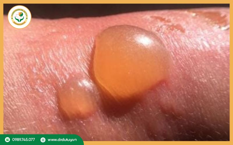 Bị bỏng rộp phải làm sao? Cách xử lý đúng giúp nhanh khỏi