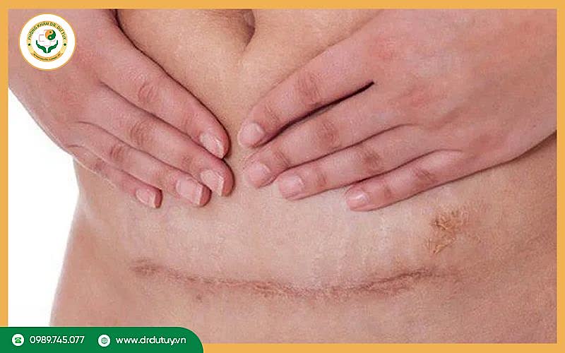 Bị dính vết mổ có nguy hiểm không? Nguyên nhân, dấu hiệu và cách phòng ngừa