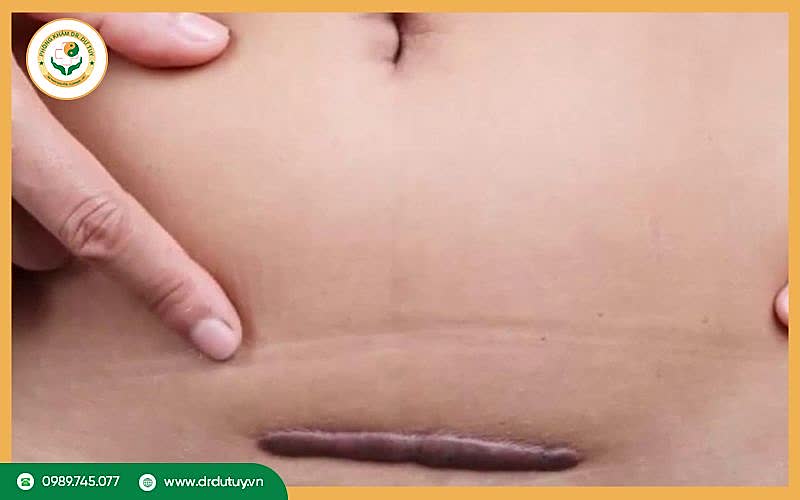 Nguyên nhân bị vết mổ bị dính
