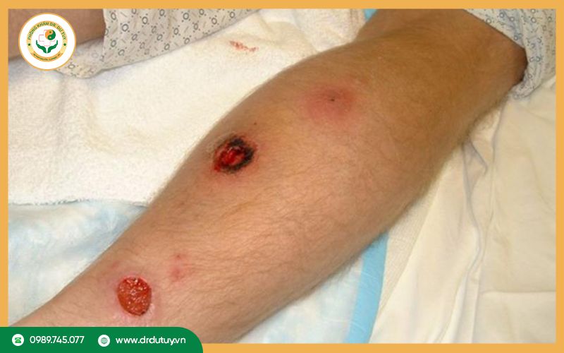 Bị loét da nên khám ở đâu? Gợi ý địa chỉ điều trị uy tín