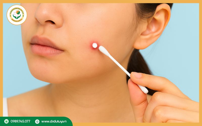 Bị mụn nhọt bao lâu thì khỏi? Cách rút ngắn thời gian phục hồi