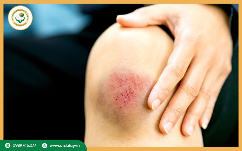 Để vết thương thông thoáng 