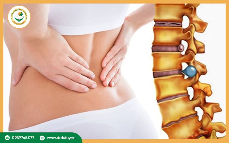 Thoát vị đĩa đệm là gì và vì sao gây đau kéo dài?