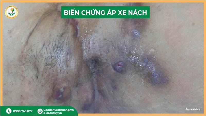biến chứng áp xe nách
