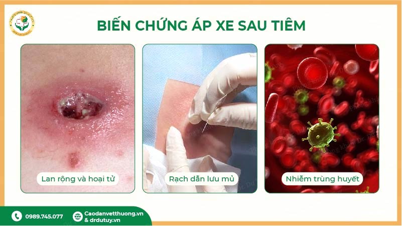 biến chứng áp xe sau tiêm hoại tử nhiễm trùng huyết