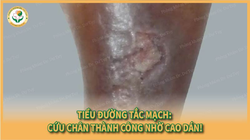 Tiểu đường tắc mạch: Cứu chân thành công nhờ Cao dán!
