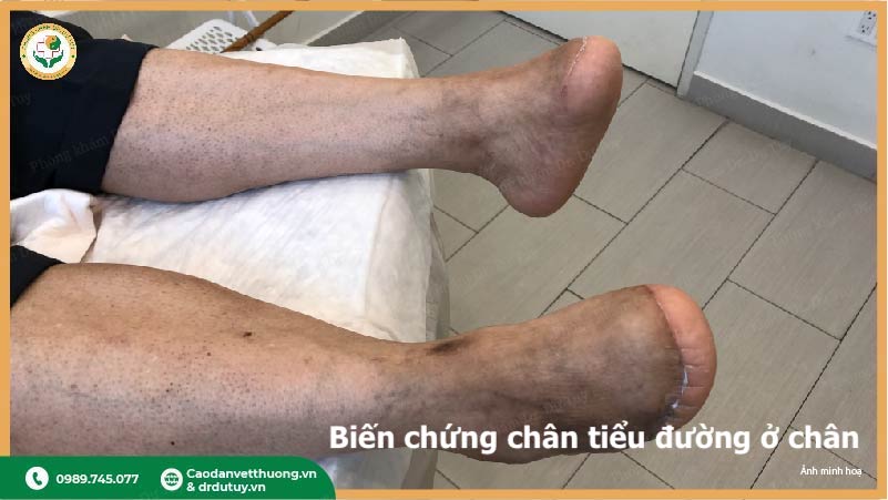 biến chứng loét bàn chân tiểu đường