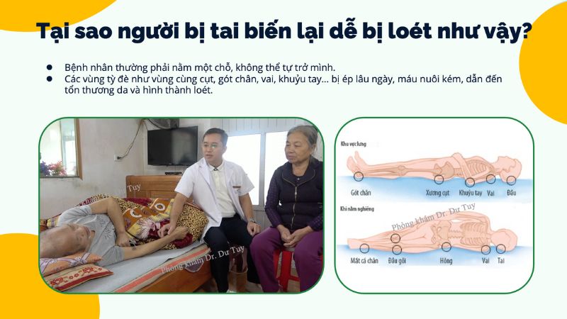 biến chứng sau tai biến