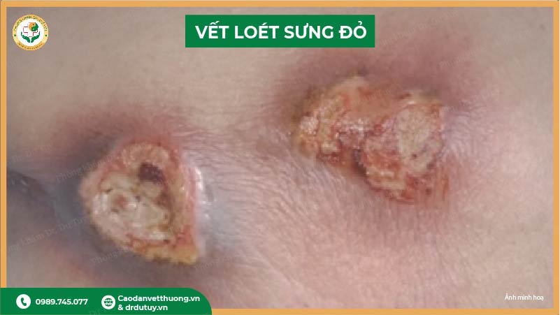 biến chứng vết loét