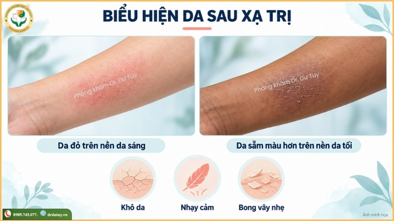 biểu hiện da sau xạ trị