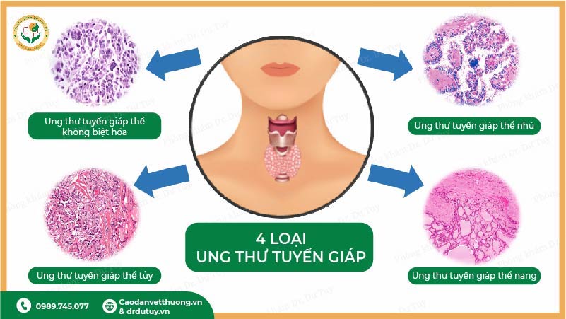 bốn loại ung thư tuyến giáp thể nhú thể nang thể tuỷ