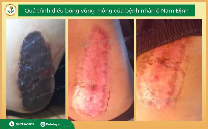 bỏng bô xe máy bị phồng rộp