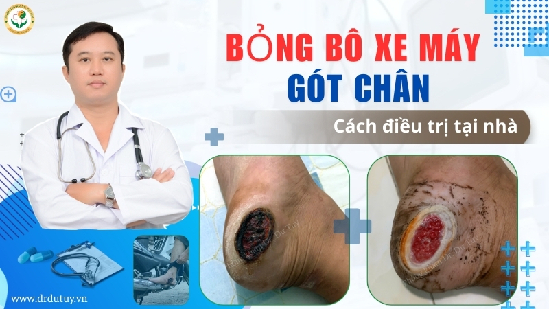 Bỏng bô xe máy bị loét hoại tử: Ca bệnh khỏi hoàn toàn sau 1 tháng
