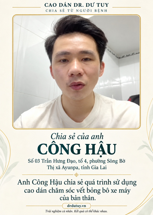 Phục hồi bỏng bô xe máy nặng